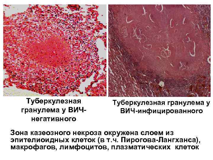 Паховая гранулема у мужчин фото