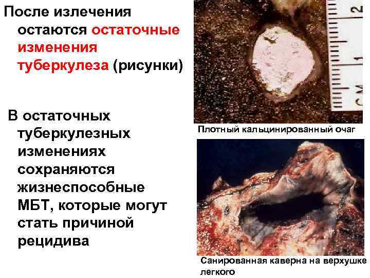 После излечения остаются остаточные изменения туберкулеза (рисунки) В остаточных туберкулезных изменениях сохраняются жизнеспособные МБТ,