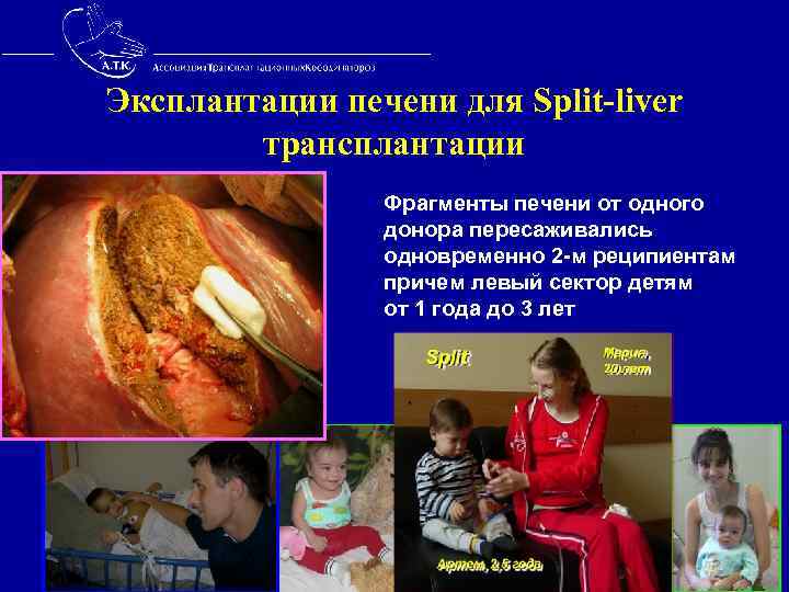 Эксплантации печени для Split-liver трансплантации Фрагменты печени от одного донора пересаживались одновременно 2 -м