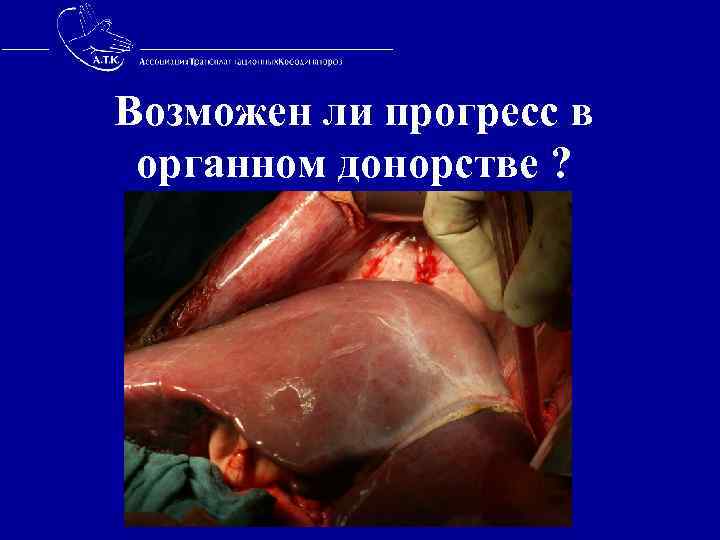 Возможен ли прогресс в органном донорстве ? 
