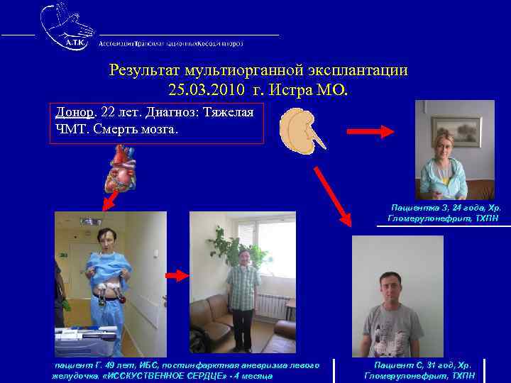  Результат мультиорганной эксплантации 25. 03. 2010 г. Истра МО. Донор. 22 лет. Диагноз: