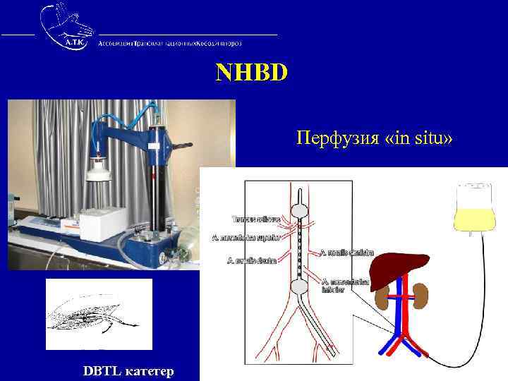  NHBD Перфузия «in situ» DBTL катетер 