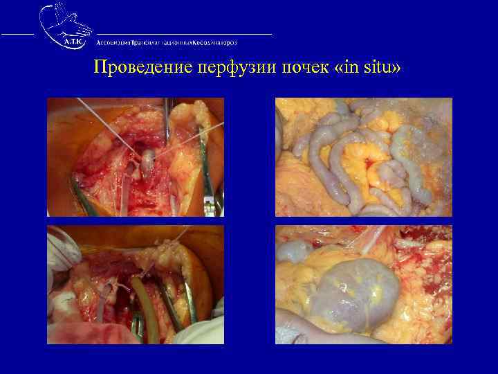 Проведение перфузии почек «in situ» 