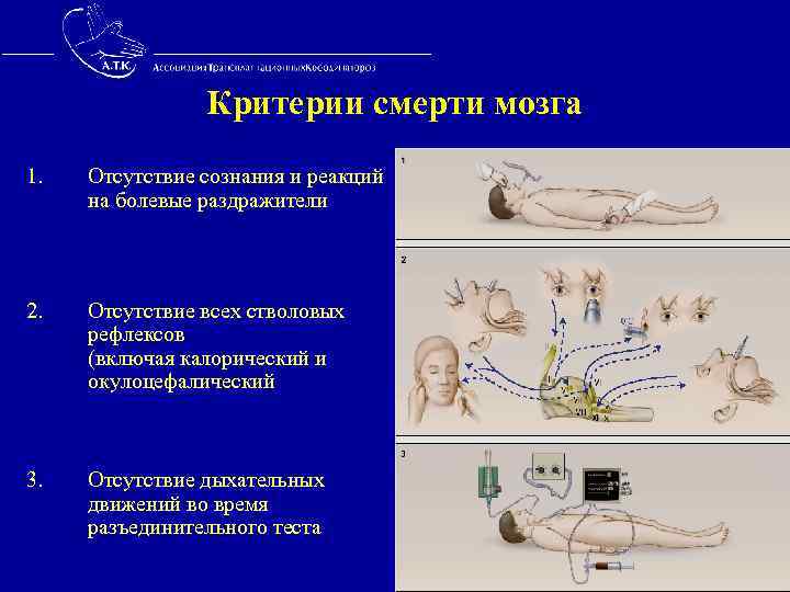  Критерии смерти мозга 1. Отсутствие сознания и реакций на болевые раздражители 2. Отсутствие