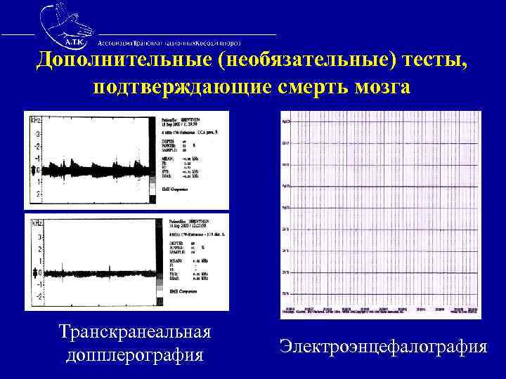 Дополнительные (необязательные) тесты, подтверждающие смерть мозга Транскранеальная допплерография Электроэнцефалография 