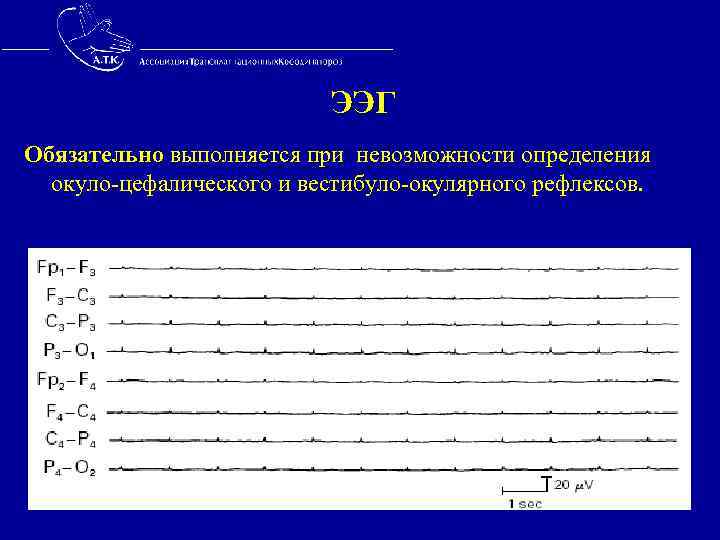  ЭЭГ Обязательно выполняется при невозможности определения окуло-цефалического и вестибуло-окулярного рефлексов. 