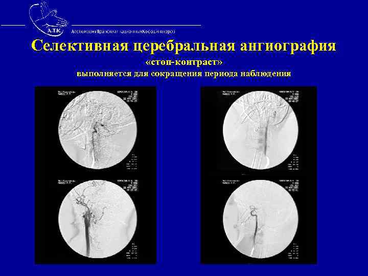 Селективная церебральная ангиография «стоп-контраст» выполняется для сокращения периода наблюдения 