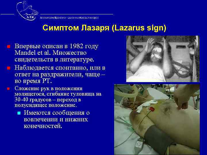  Симптом Лазаря (Lazarus sign) n Впервые описан в 1982 году Mandel et al.