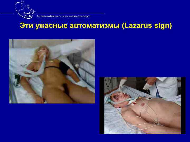 Эти ужасные автоматизмы (Lazarus sign) 