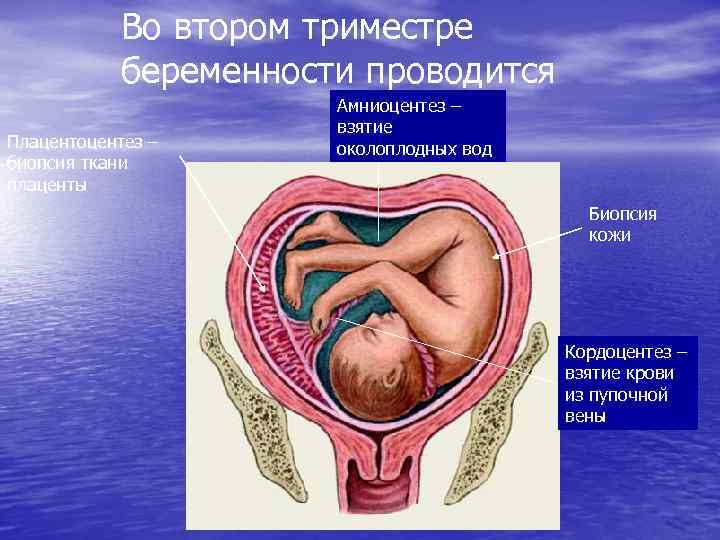 Во втором триместре беременности проводится Плацентоцентез – биопсия ткани плаценты Амниоцентез – взятие околоплодных