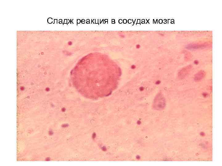 Сладж реакция в сосудах мозга 