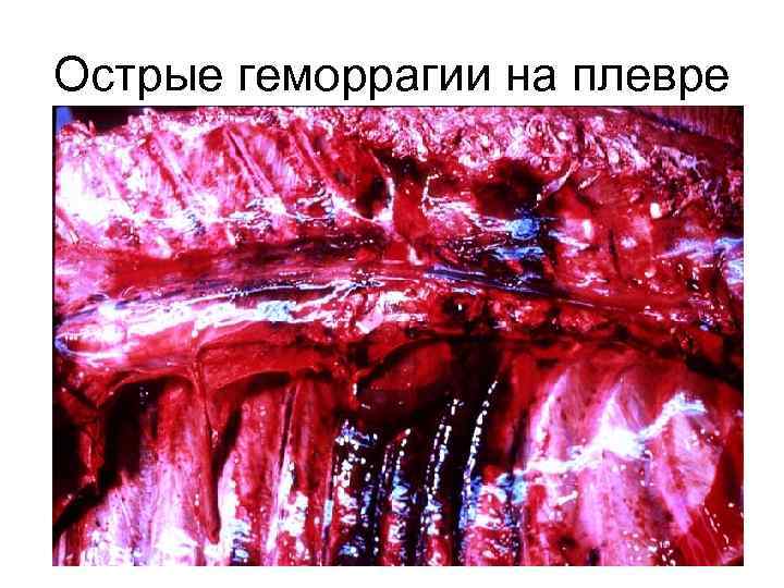 Острые геморрагии на плевре 