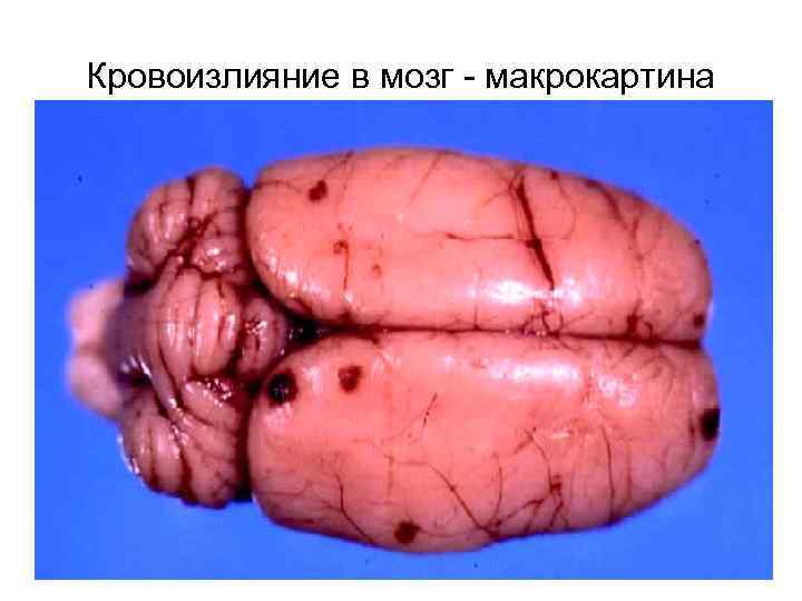Кровоизлияние в мозг - макрокартина 