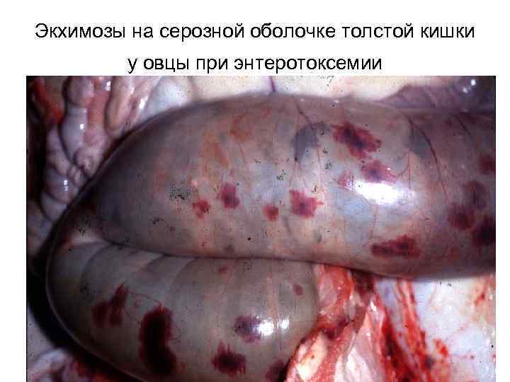 Экхимозы на серозной оболочке толстой кишки у овцы при энтеротоксемии 