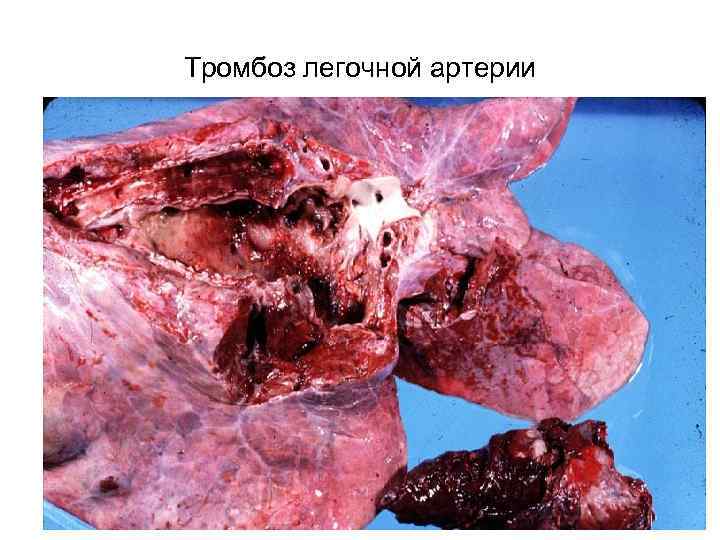 Тромбоз легочной артерии 