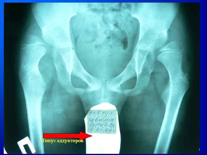Тонус аддукторов 