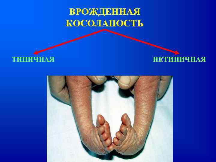 ВРОЖДЕННАЯ КОСОЛАПОСТЬ ТИПИЧНАЯ НЕТИПИЧНАЯ 