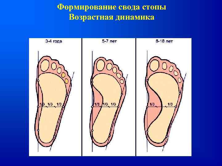 Формирование свода стопы Возрастная динамика 