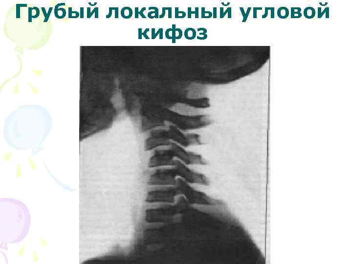 Грубый локальный угловой кифоз 