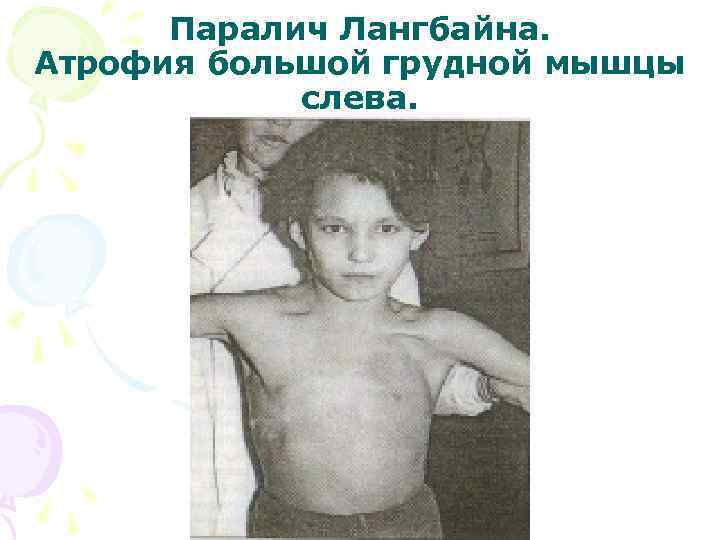 Паралич Лангбайна. Атрофия большой грудной мышцы слева. 