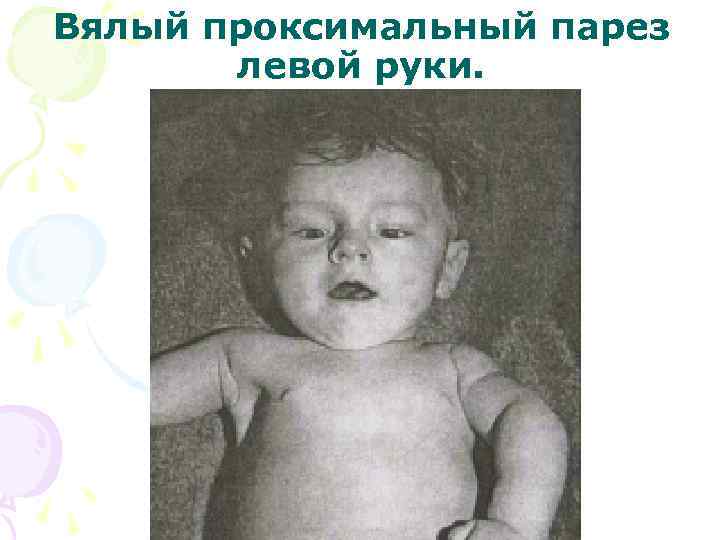 Вялый проксимальный парез левой руки. 