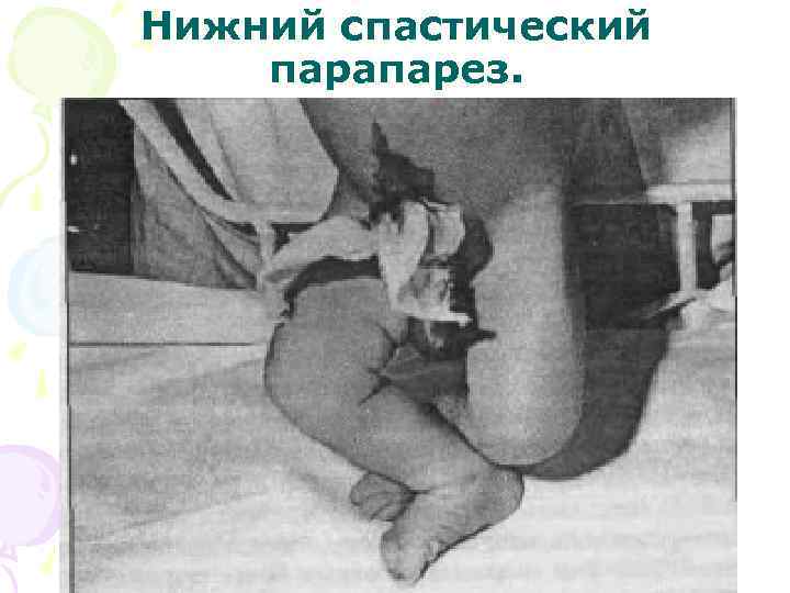 Нижний спастический парапарез. 