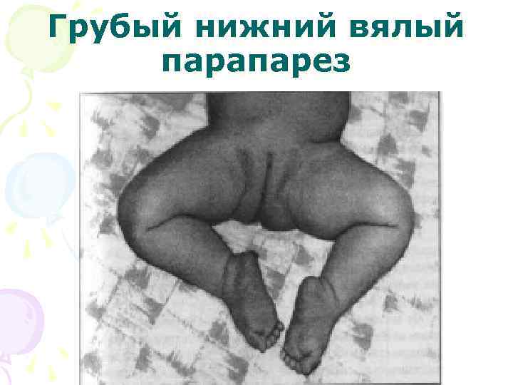 Грубый нижний вялый парапарез 