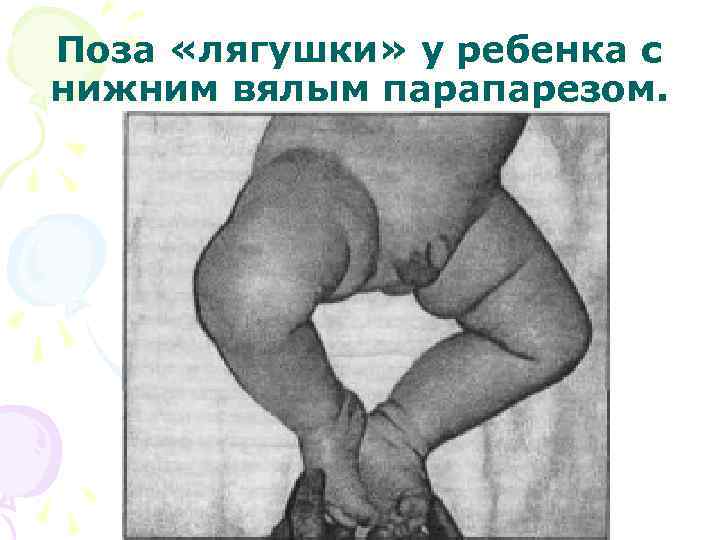 Поза «лягушки» у ребенка с нижним вялым парапарезом. 