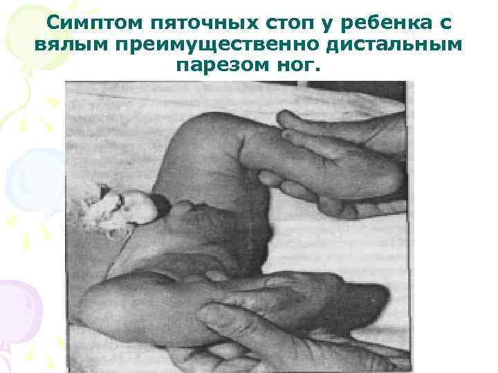 Симптом пяточных стоп у ребенка с вялым преимущественно дистальным парезом ног. 