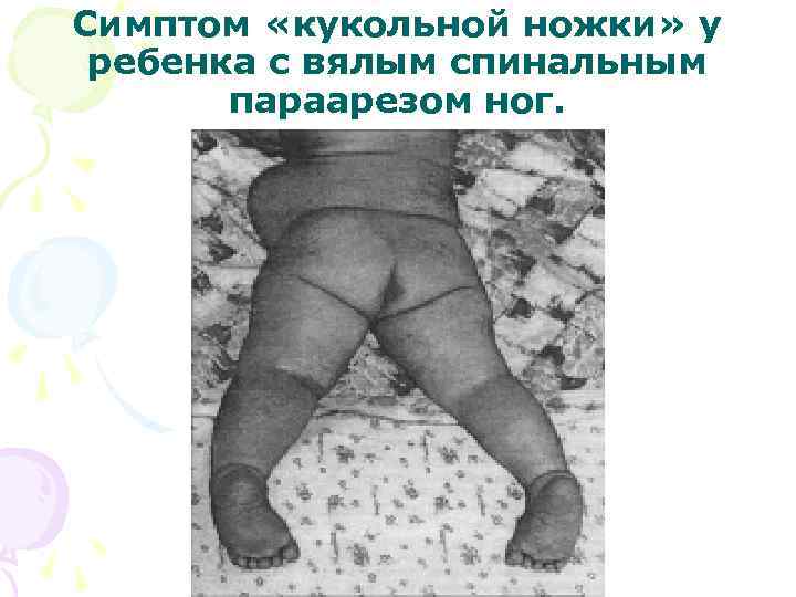 Симптом «кукольной ножки» у ребенка с вялым спинальным параарезом ног. 