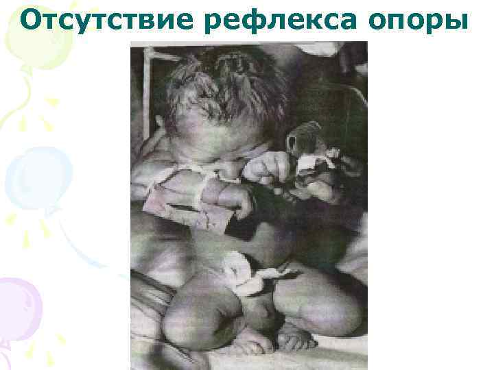 Отсутствие рефлекса опоры 