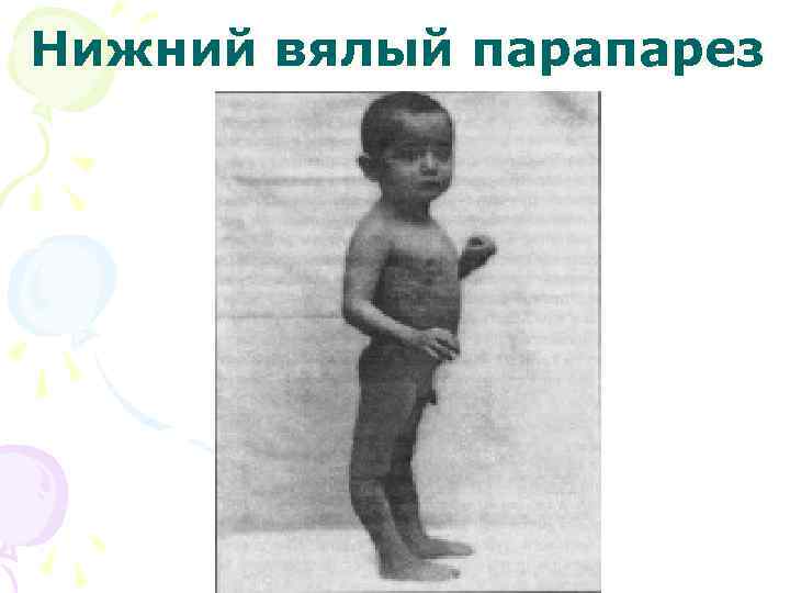 Нижний вялый парапарез 