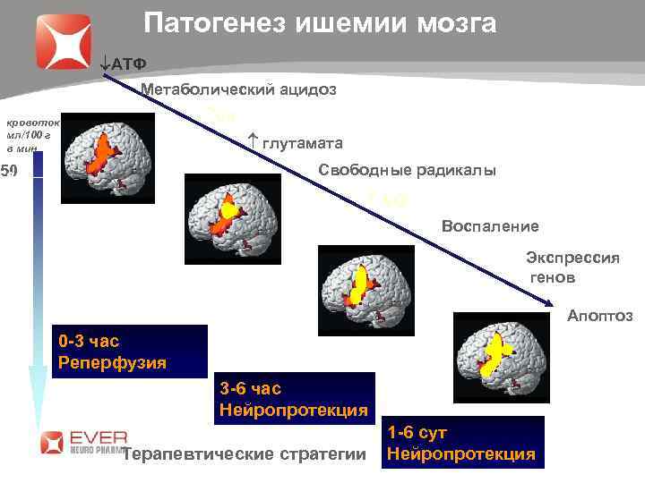 Патогенез ишемии мозга АТФ Метаболический ацидоз Ca кровоток мл/100 г в мин глутамата 40