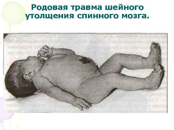  Родовая травма шейного утолщения спинного мозга. 