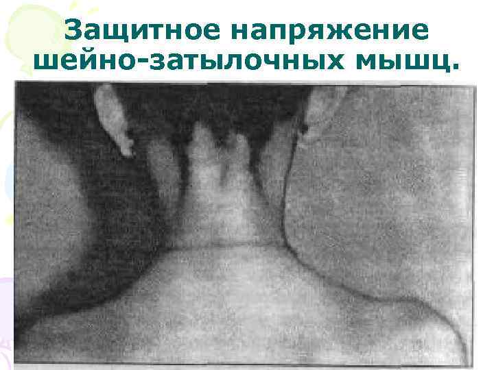 Защитное напряжение шейно-затылочных мышц. 