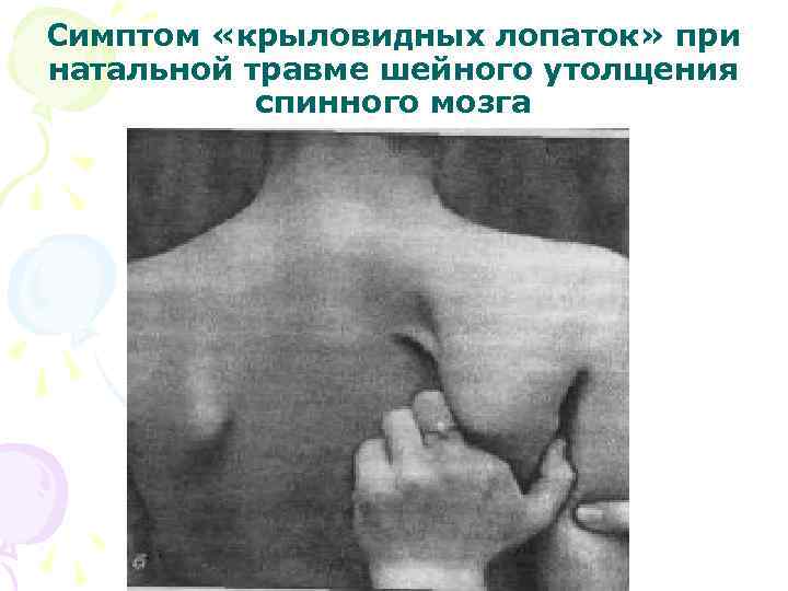 Симптом «крыловидных лопаток» при натальной травме шейного утолщения  спинного мозга 