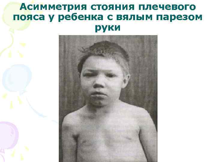  Асимметрия стояния плечевого пояса у ребенка с вялым парезом    руки