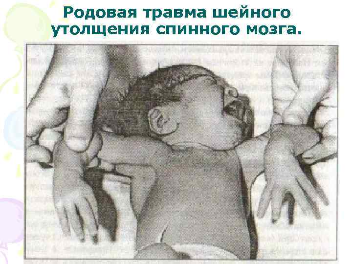  Родовая травма шейного утолщения спинного мозга. 