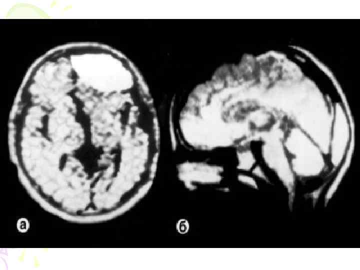  Субдуральные кровоизлияния (возникают при деформации черепа со смещением его пластин, источник –вены впадающие