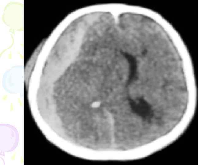 Клиника супратенториального кр/я беспокойство, напряжение родничков, запрокидывание головы, расхождение черепных швов, с/м Грефе, 