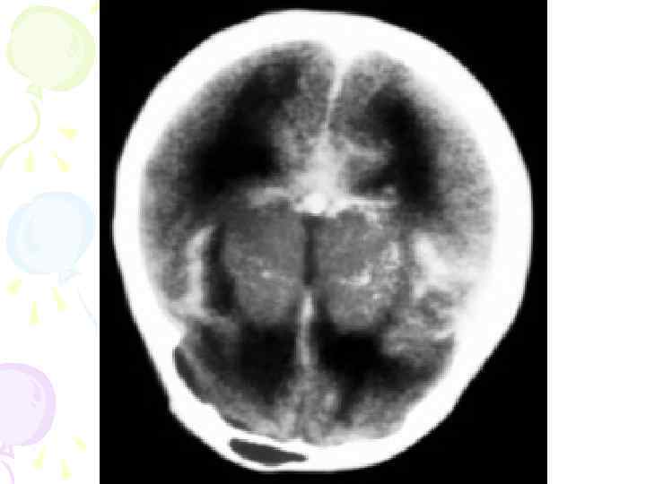 Данные рентгенологического  исследования:  ²Симптомы повышения внутричерепного давления – 72% ;  ²
