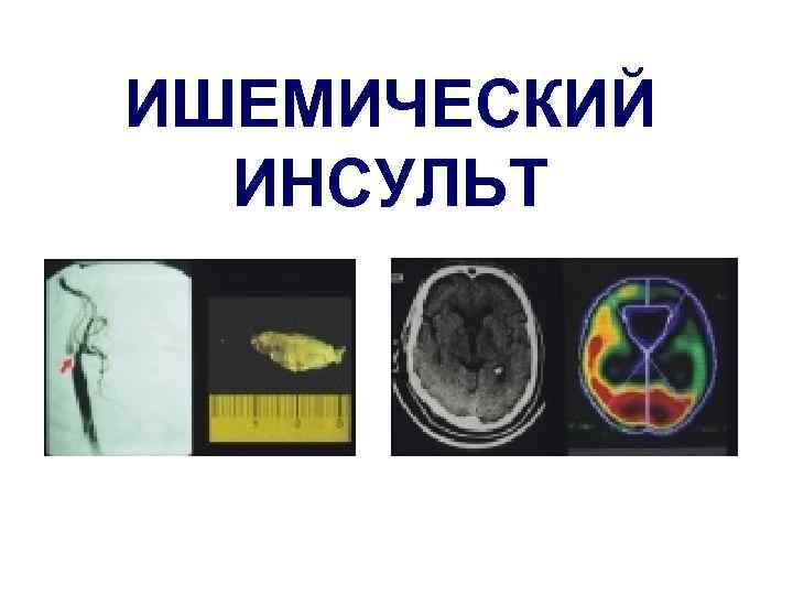 ИШЕМИЧЕСКИЙ ИНСУЛЬТ 