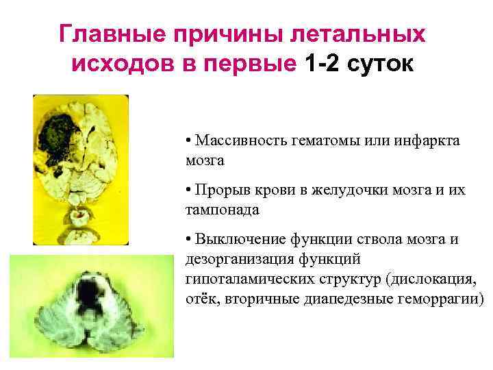 Главные причины летальных исходов в первые 1 -2 суток • Массивность гематомы или инфаркта