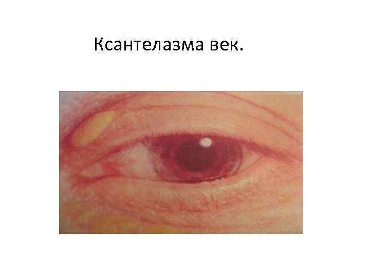 Ксантелазма век. 