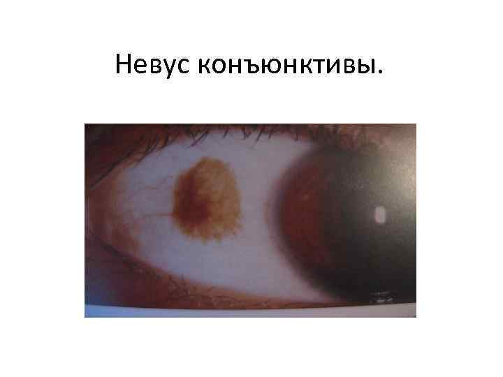 Невус конъюнктивы. 