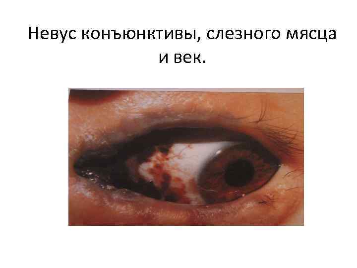 Невус конъюнктивы, слезного мясца и век. 