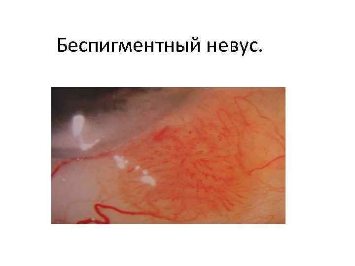 Беспигментный невус. 