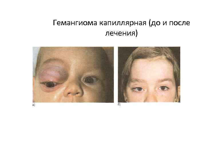 Гемангиома капиллярная (до и после лечения) 