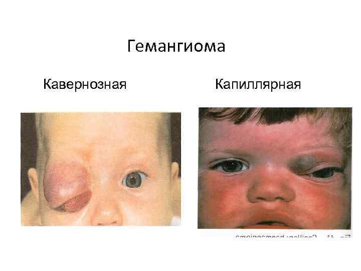 Гемангиома Кавернозная Капиллярная 