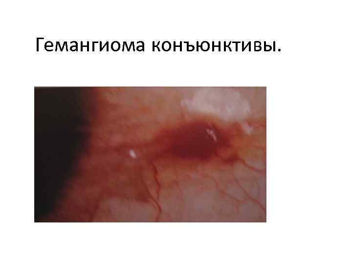 Гемангиома конъюнктивы. 